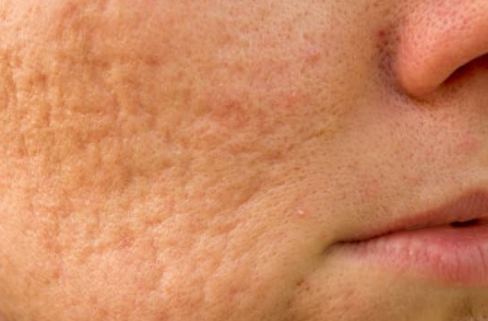 Microneedling Cicatrices d’Acné Zepharma ⚜ – Régénération et peau lissée