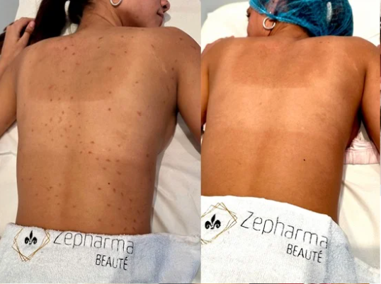 Peeling Eclair Zepharma - Retrouvez l’éclat naturel de votre peau grâce au Peeling Éclair Zepharma.