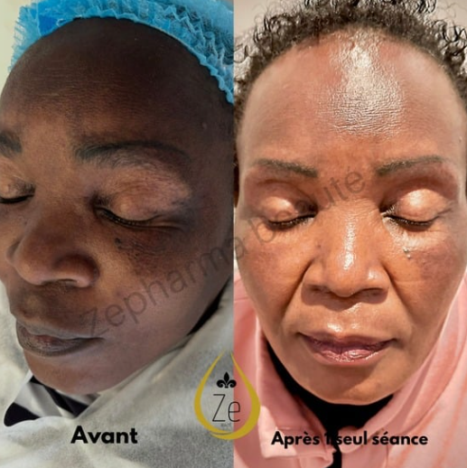 Peeling Eclair Zepharma - Retrouvez l’éclat naturel de votre peau grâce au Peeling Éclair Zepharma.