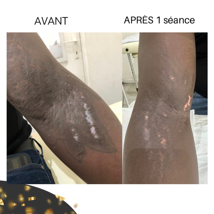 Peeling Vergetures Zepharma ⚜ – Soin rénovateur pour une peau lissée et uniforme