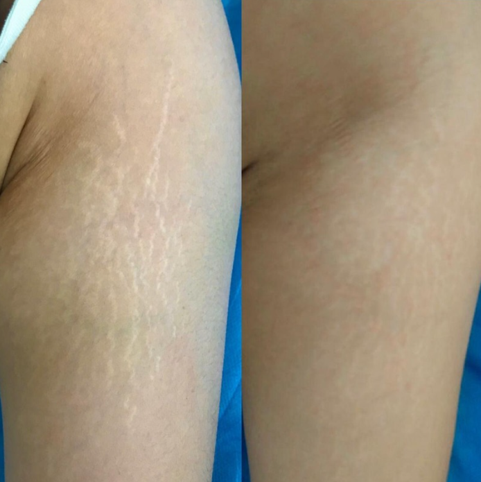 Peeling Vergetures Zepharma ⚜ – Soin rénovateur pour une peau lissée et uniforme