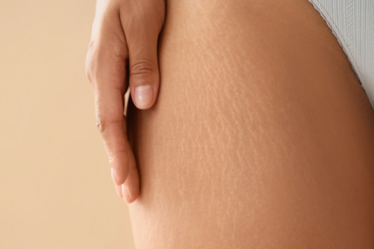 Peeling Vergetures Zepharma ⚜ – Soin rénovateur pour une peau lissée et uniforme